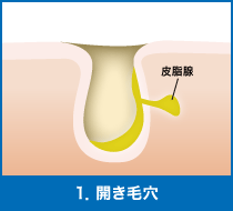1．開き毛穴