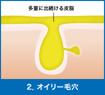 2．オイリー毛穴