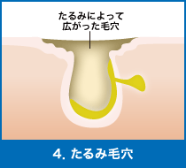 4．たるみ毛穴