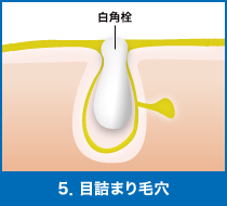 5．目詰まり毛穴