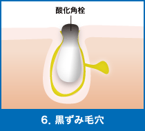 6．黒ずみ毛穴